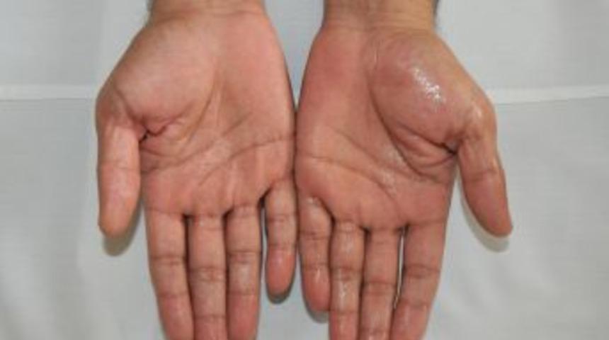 Aşırı El Ve Koltuk Altı Terlemesine Kesin &Ccedil;&ouml;z&uuml;m