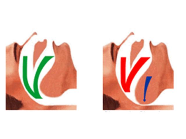 10. Uyurken dişleri sıkmak 1