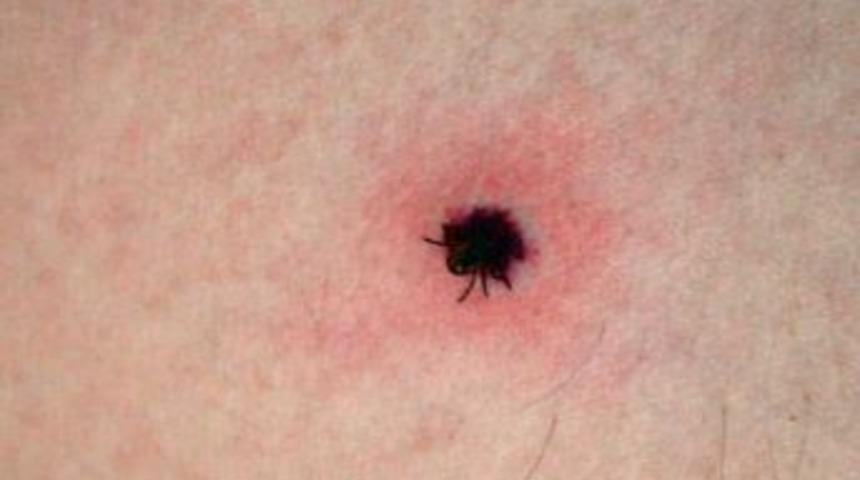 Erzincan Gıda Tarım Ve Hayvancılık M&uuml;d&uuml;rl&uuml;ğ&uuml;'nden Kene Uyarısı