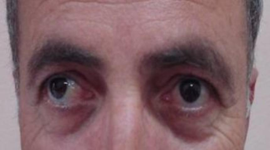 Şaşılık Artık Tarih Oluyor