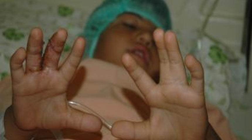 Yapışık Parmakları Ayrıldı, 6. Parmağı Da Alındı