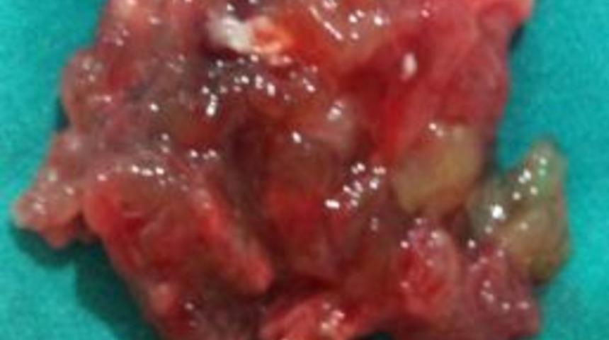 &Ccedil;om&uuml; Tıp Fak&uuml;ltesi'nde A&ccedil;ık Kalp Ameliyatı