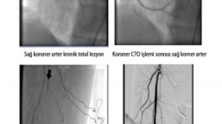 Cto'lu Hastalara Ameliyatsız &Ccedil;&ouml;z&uuml;m