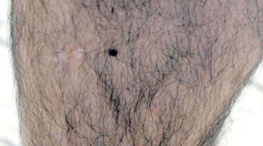 Hayvan Sağlığı Teknikerini Isıran Kene Hastanede &Ccedil;ıkarıldı