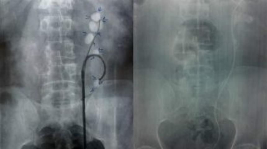 B&ouml;brek Taşı Tedavisinde Yeni D&ouml;nem