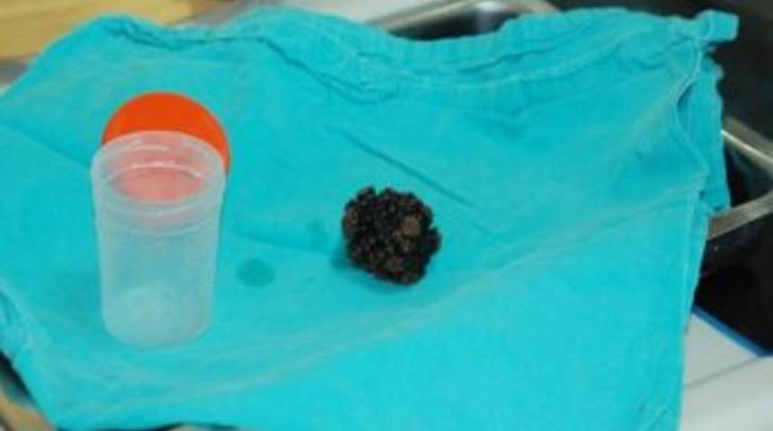 Mesanesinden Yumurta B&uuml;y&uuml;kl&uuml;ğ&uuml;nde Taş &Ccedil;ıktı