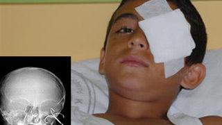 Olta kancası gözüne saplandı