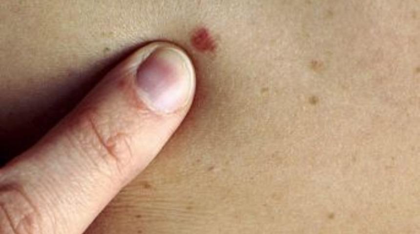 Deri Kanserine Karşı Benlere Dikkat