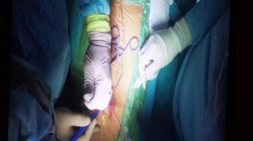 Omurga Eğrilikleri Ve Şekil Bozukluklarına Yeni Ameliyat Tekniği