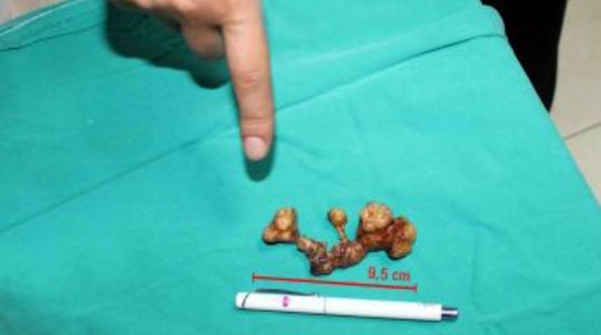 Tansiyon Şikayeti Ile Geldi, Böbrek Taşı Çıktı