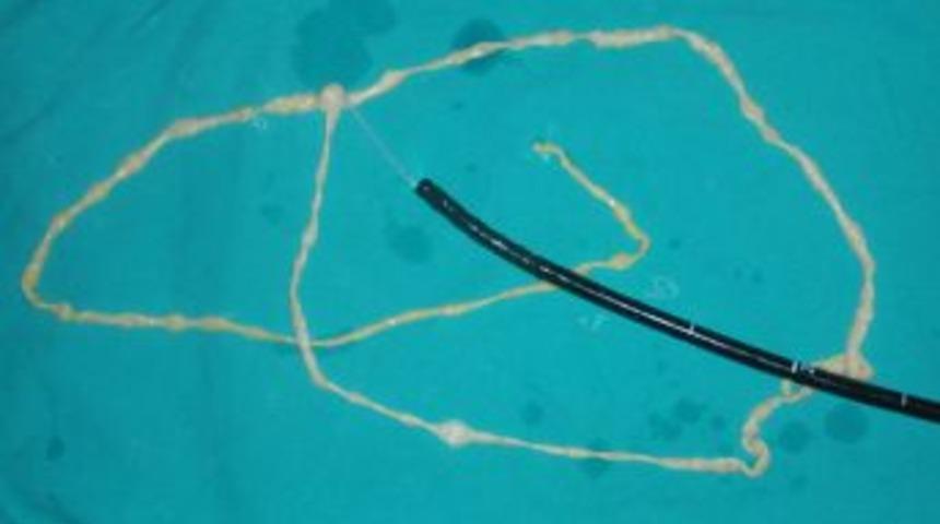 Karın Ağrısı Şikayetiyle Geldi, Karnından 2,5 Metre Solucan &Ccedil;ıktı