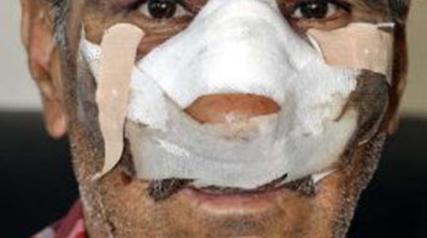 Zabıta 'burnunu kırdı'