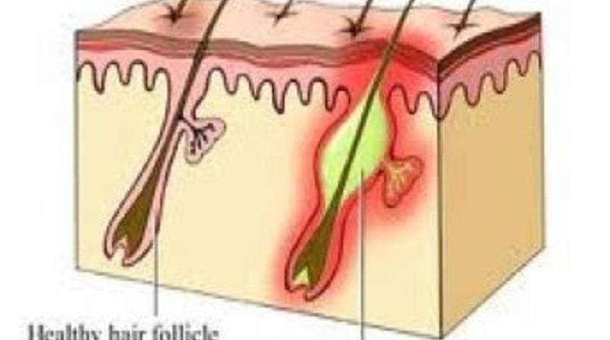 Erkeklerin Korkulu R&uuml;yası: Kıl D&ouml;nmesi&hellip;
