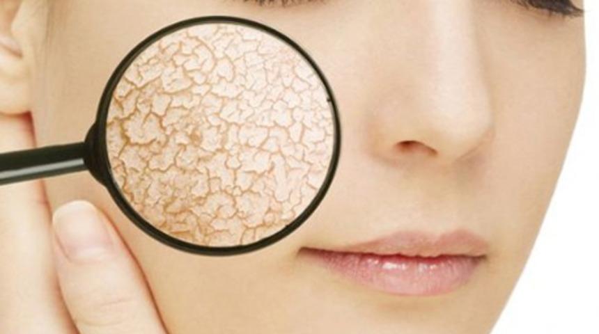 Kış aylarında cilt kuruluğunu &ouml;nlemenin yolları!
