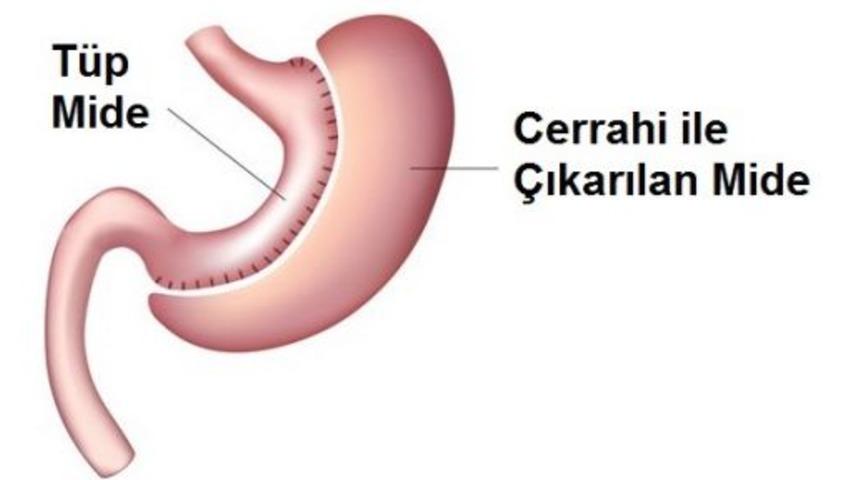 Mide küçültme ameliyatı riskleri hastaların korkulu rüyası!