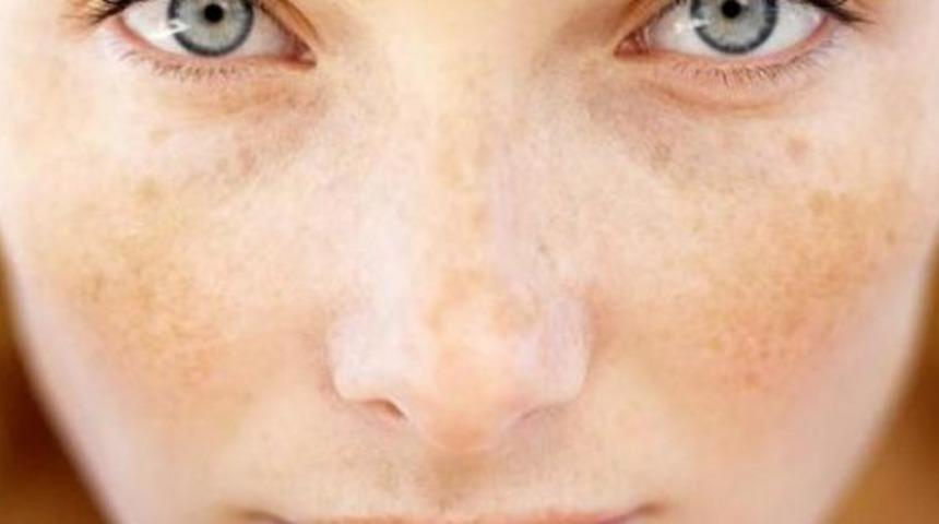 Güneş lekesi tedavisi için ne yapmak gerekir? Güneş lekesi kansere dönüşmesin