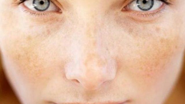 Güneş lekesi tedavisi için ne yapmak gerekir? Güneş lekesi kansere dönüşmesin