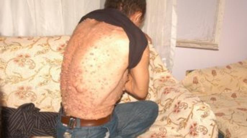 V&uuml;cudunu Saran Yaralara Teşhis Konulamıyor