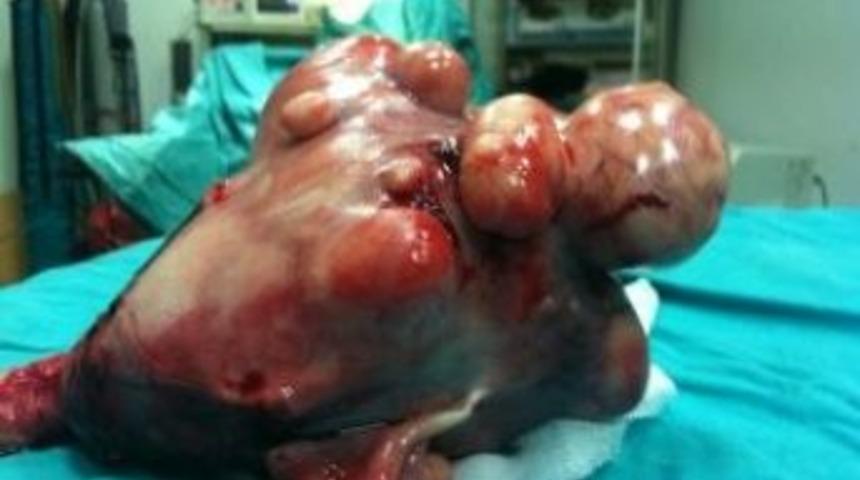 Karnından Karpuz B&uuml;y&uuml;kl&uuml;ğ&uuml;nde Ur &Ccedil;ıktı