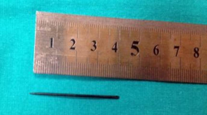 Kalbine Saplanan 5 Santimetrelik Iğne Ameliyatla &Ccedil;ıkarıldı