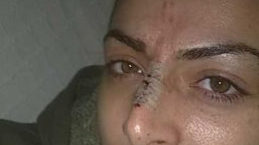 (&ouml;zel Haber) K&ouml;peği Severken Y&uuml;z&uuml;nden Yaralandı