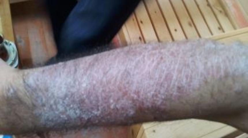 Hisarcık Esire Kaplıcaları'nda Sedef Hastalığı Tedavisinde Olumlu Gelişme