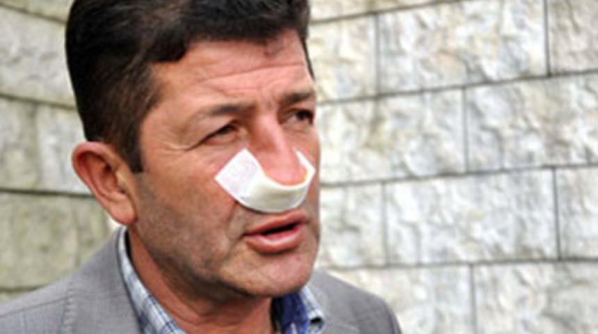 Ambulans s&uuml;r&uuml;c&uuml;s&uuml;n&uuml;n burnunu kırdı