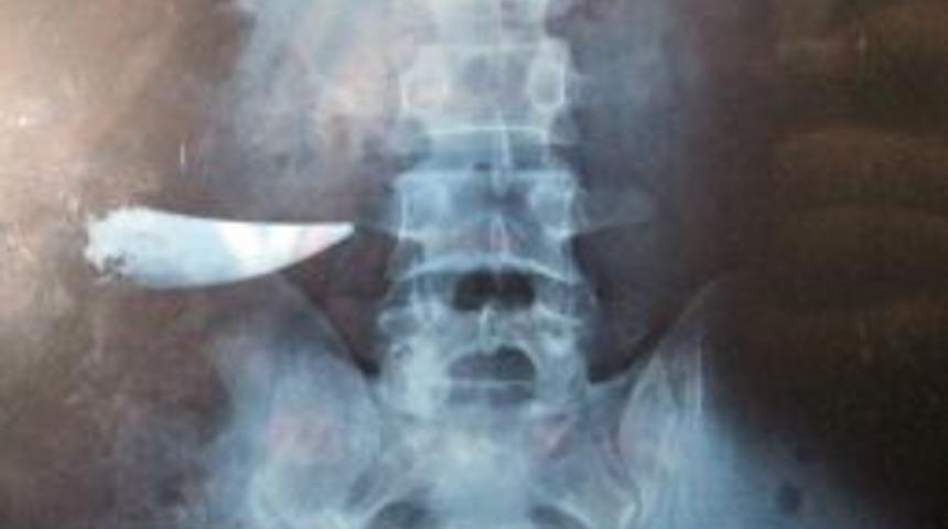 Karnında Unutulan Bı&ccedil;akla 9 Yıl Yaşamış