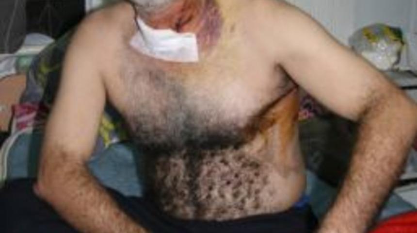 &Ouml;zg&uuml;r Bir &Uuml;lkede Yaşamak İ&ccedil;in Bedenlerinden Bir Par&ccedil;a Kaybettiler