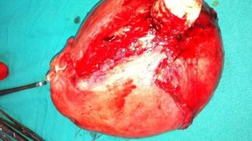 Karnından 2 Kilogram Kist &Ccedil;ıktı