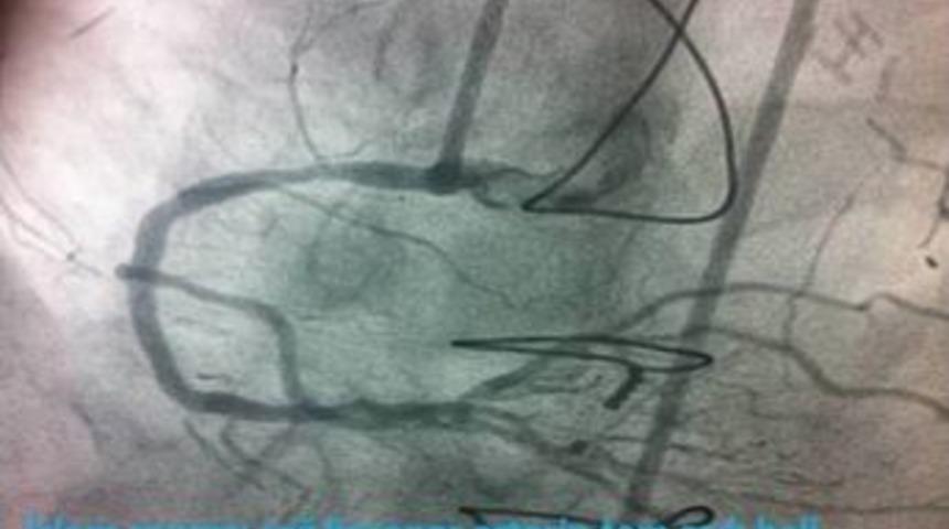 BA&Uuml;'de Tam Tıkalı Kalp Damarına Ameliyatsız M&uuml;dahale Edildi