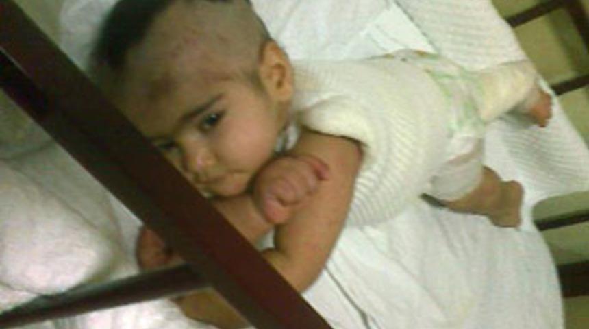 Sıcak suyla haşlandı, enfeksiyonundan &ouml;ld&uuml;