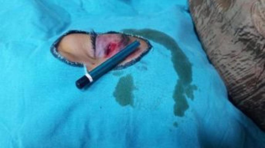 K&uuml;&ccedil;&uuml;k Dilara 1 Santimetre İle K&ouml;r Olmaktan Kurtuldu