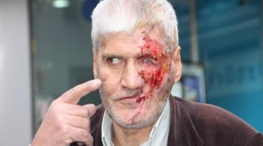 Maganda Kurşunu Ile Hayatı Karardı, Y&uuml;z Nakli I&ccedil;in Yardım Bekliyor