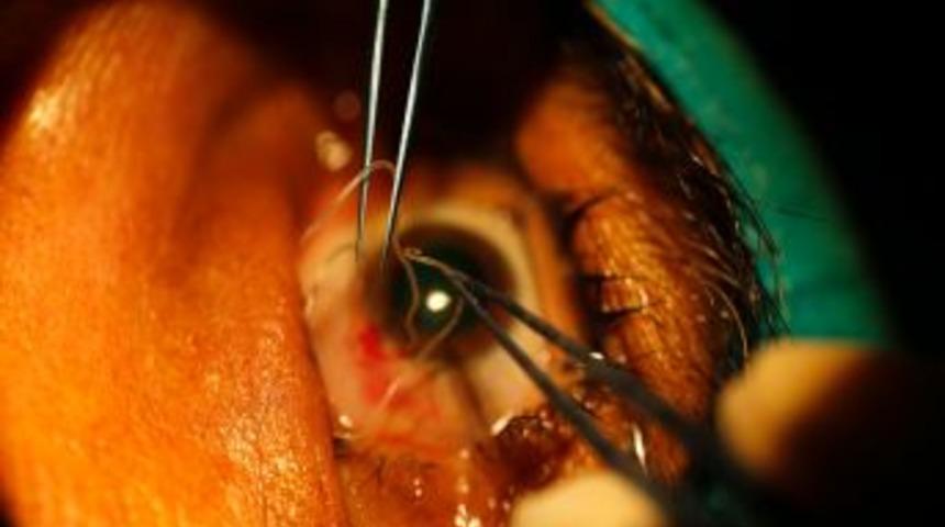 G&ouml;z&uuml;nden solucan &ccedil;ıktı