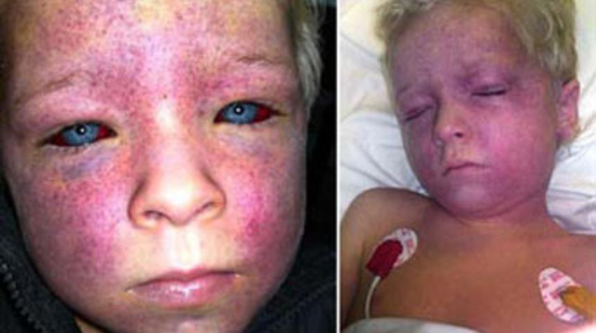 Y&uuml;z ve g&ouml;zlerindeki damarlar patladı