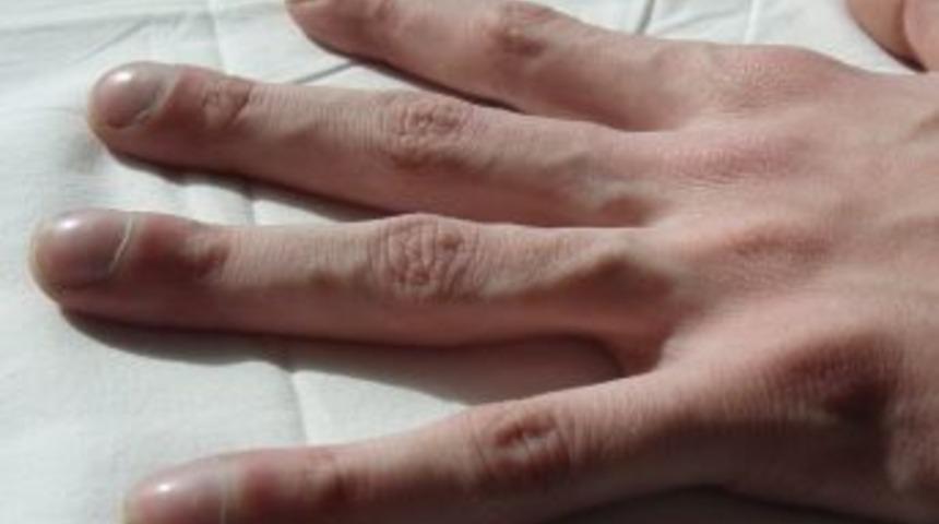 Parmaklardaki &Ccedil;omaklaşma Hastalık Belirtisi Olabilir