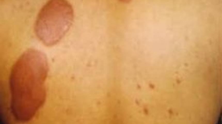 Didim Toplum Sağlığı Merkezi'nden C&uuml;zzam Bilgilendirmesi