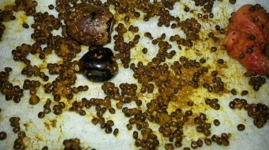 Safra Kesesinden 300 Adet Taş &Ccedil;ıktı