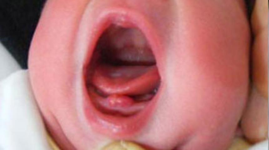 İki dişli doğan bebek şaşkınlık yarattı