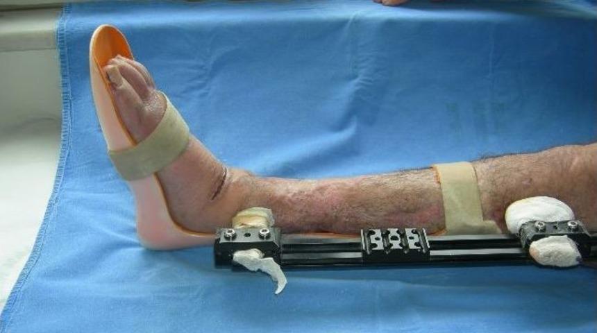 (&ouml;zel Haber) Koparak Kısalan Bacağa Aynı Anda Uzatma İşlemi De Yapılıyor