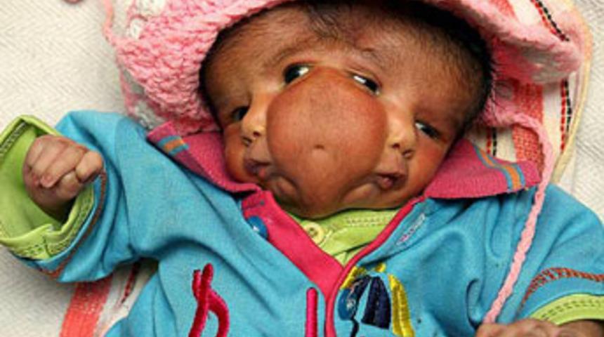 İki y&uuml;zl&uuml; &ccedil;ocuk doğdu