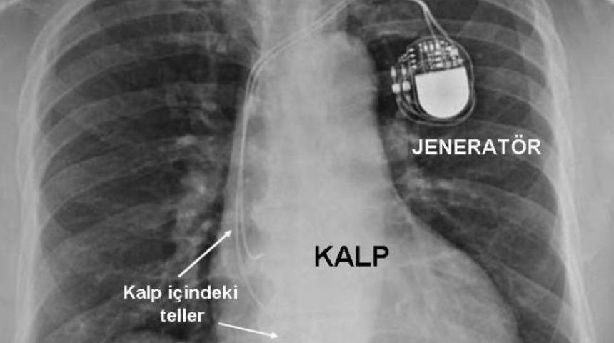 (özel Haber) Mr Uyumlu Kalp Pilleri Hasta İçin Avantaj