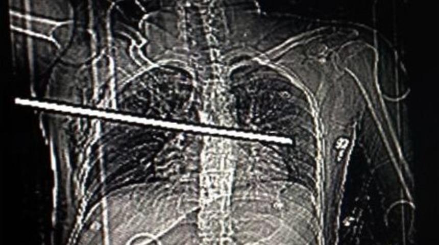 V&uuml;cuduna 35 cantimlik demir saplandı