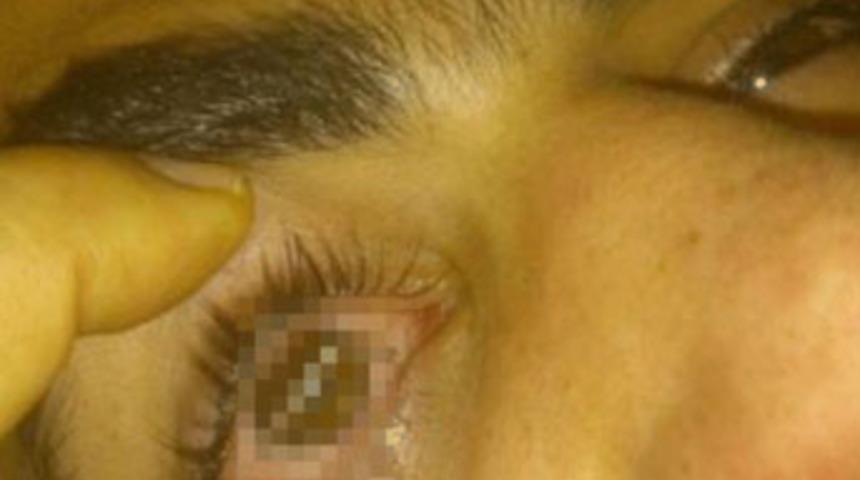 D&ouml;şeme zımbasının teli g&ouml;z&uuml;ne saplandı