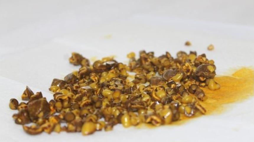 Taş Ocağı Gibi Safra Kesesi