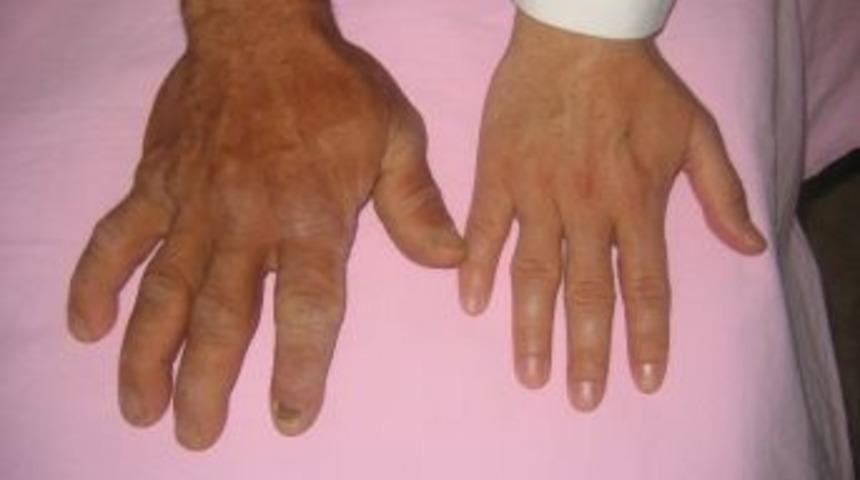 B&uuml;y&uuml;me Hastalığı Akromegali&rsquo;yi K&uuml;&ccedil;&uuml;msemeyin&hellip;