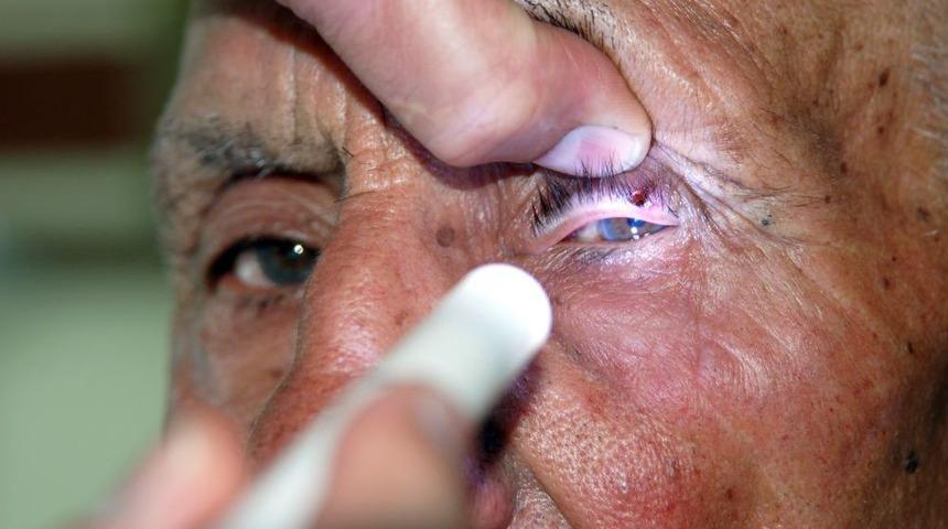 Gözünden kene çıkarıldı