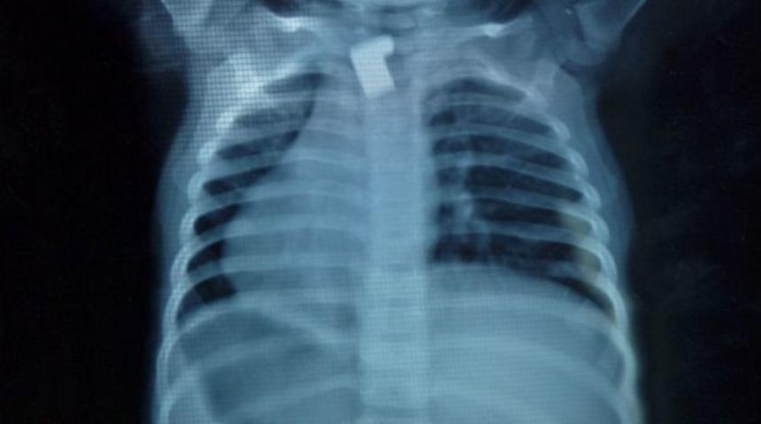 Yemek Borusuna Takılı Anahtar Par&ccedil;ası Bulundu