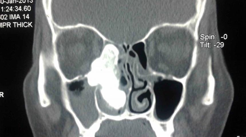 Burun Kanalından Ceviz B&uuml;y&uuml;kl&uuml;ğ&uuml;nde T&uuml;m&ouml;r &Ccedil;ıktı